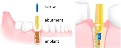 Silver coating on dental implant-abutment connection screws as potential strategy to prevent loosening and minimizing bacteria adhesion